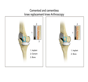 Cementless Total Knee Arthroplasty