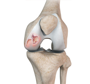 Chondral or Articular Cartilage Defects