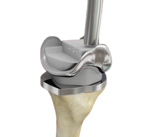 Complex Primary Knee Replacement