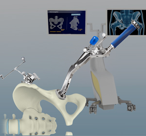 Computer-assisted Hip Replacement