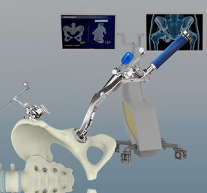 Computer-Navigated Total Hip Replacement