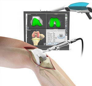 Computer Navigation for Total Knee Replacement