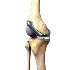 Custom Knee Replacement