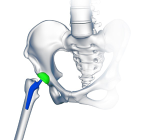Custom/Patient-Specific Hip Replacement