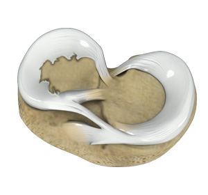 Degenerative Meniscal Tears