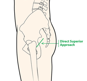 Direct Superior Hip Replacement