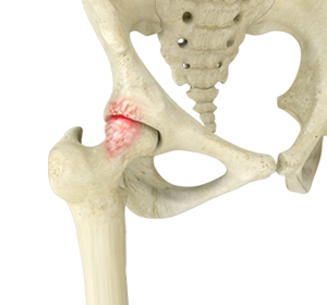 Femoroacetabular Impingement