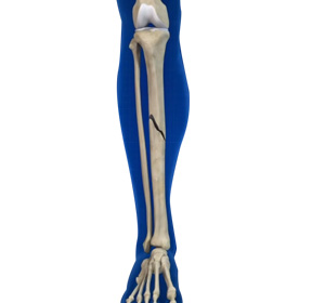 Fractures of the Tibia