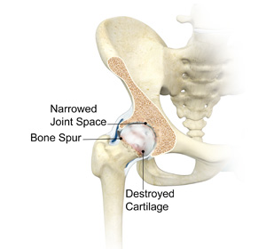 Arthritis