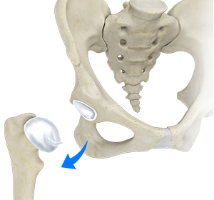 Hip Dislocation