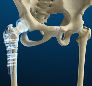 Fracture Surgery