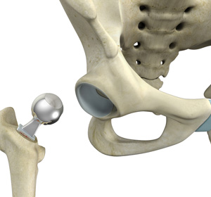 Hip Hemiarthroplasty