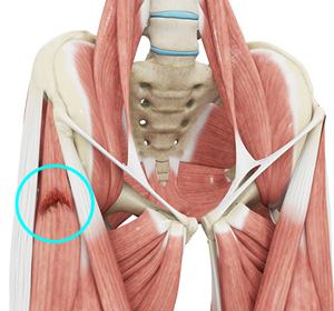 Hip Muscle Strain
