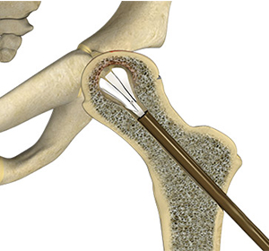 Hip Reconstruction