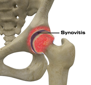 Hip Synovitis