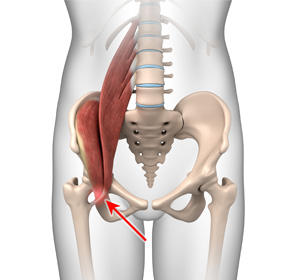 Iliopsoas Tendonitis