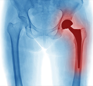 Inpatient Hip Replacement