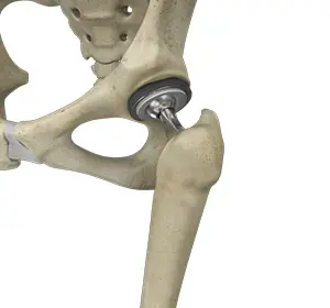 Joint Replacement