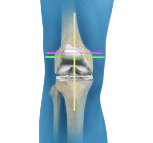 Kinematic Alignment (TKA)