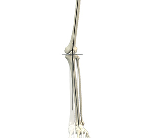 Knee Angular Deformities