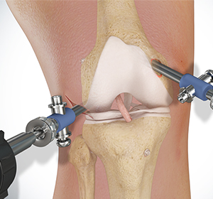 Knee Surgery