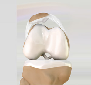 Lateral Patellar Compression Syndrome