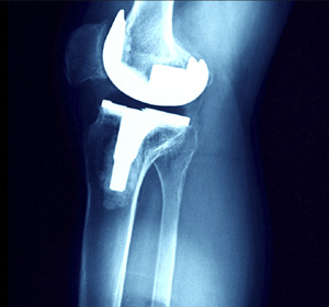Management of Complex Previous Knee Surgery