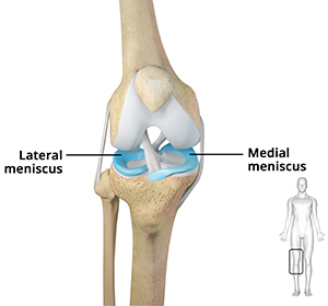 Meniscectomy