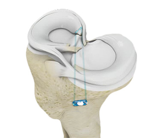 Meniscus Root Repair