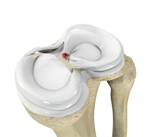 Meniscus Root Tear