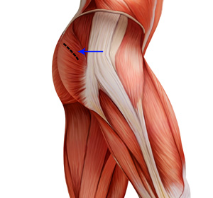 Mini-Posterior Hip Replacement