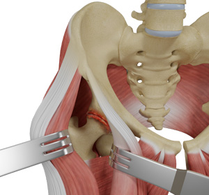 Muscle-Sparing Anterolateral Approach Total Hip Replacement