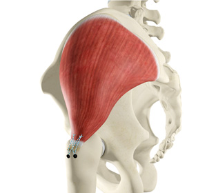 Open Gluteus Medius Repair