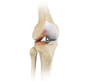 Osteoarthritis Management