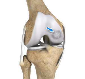 Osteochondral Defect of the Knee