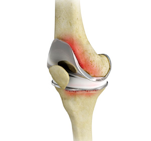 Painful or Failed Total Knee Replacement