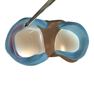 Partial Arthroscopic Meniscectomy
