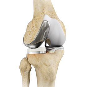 Partial Knee Resurfacing