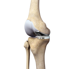 Partial Medial Knee Replacement