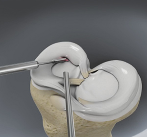 Partial Meniscectomy