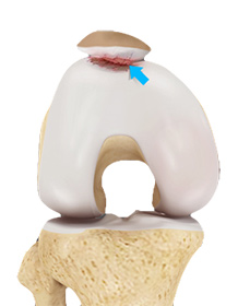 Patellofemoral Arthritis
