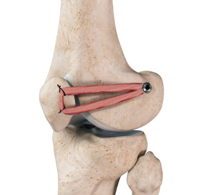 Patellofemoral Knee Replacement