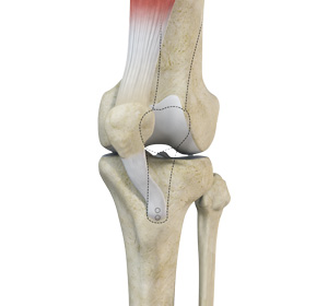 Patellofemoral Realignment