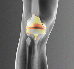 Patient Specific Knee Replacement