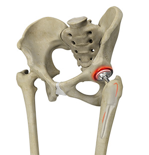 Periprosthetic Hip Fracture Management