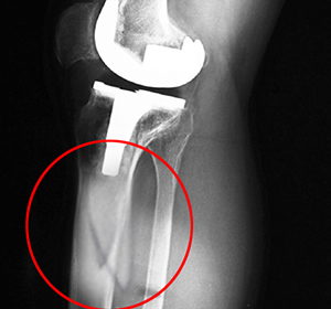 Periprosthetic Knee Fractures