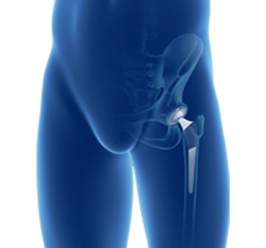 Primary Hip Replacement