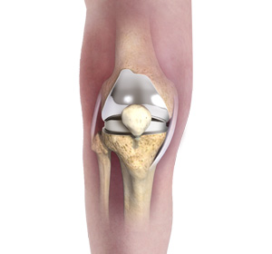 Primary Knee Replacement