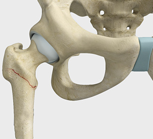 Proximal Femoral Fracture