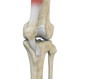 Recurrent Patella Dislocation